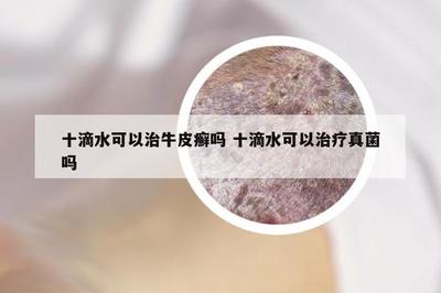 十滴水对牛皮癣、真菌感染的适用性及银屑病预防建议