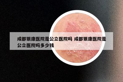 成都银康医院是否公立及银屑病预防咨询全解析