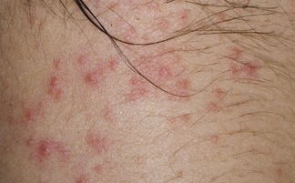 青壮年如何科学预防银屑病 远离皮肤困扰的健康指南