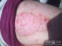 银屑病 全面了解预防策略与科学治疗方法