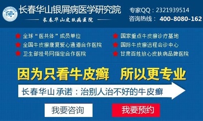 银屑病防治指南 长春优质医院推荐与预防咨询